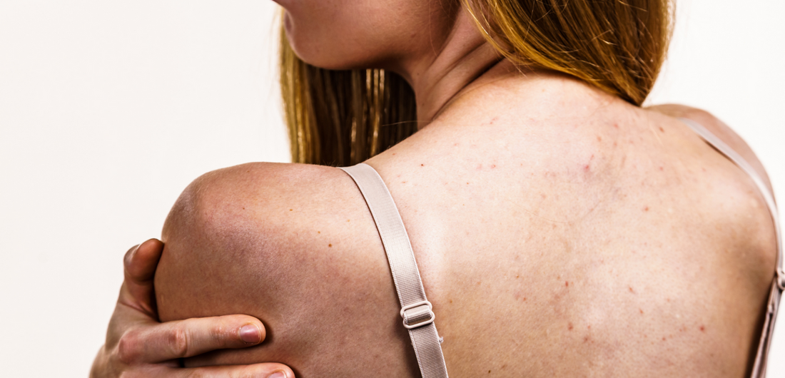 Back Acne: Everything You Need To Know About Them