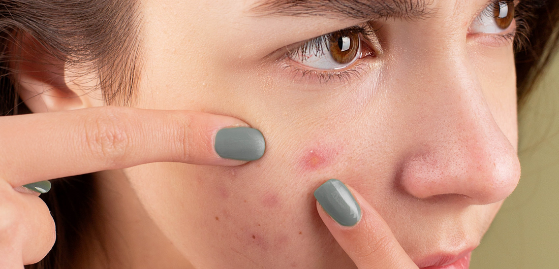 Acne Guide: Types, Causes & Treatment